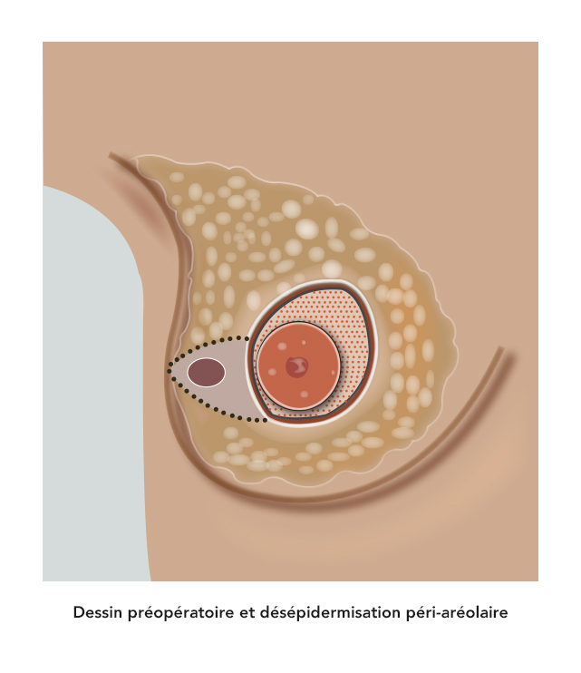 Cancer du sein : Diagnostique et traitements